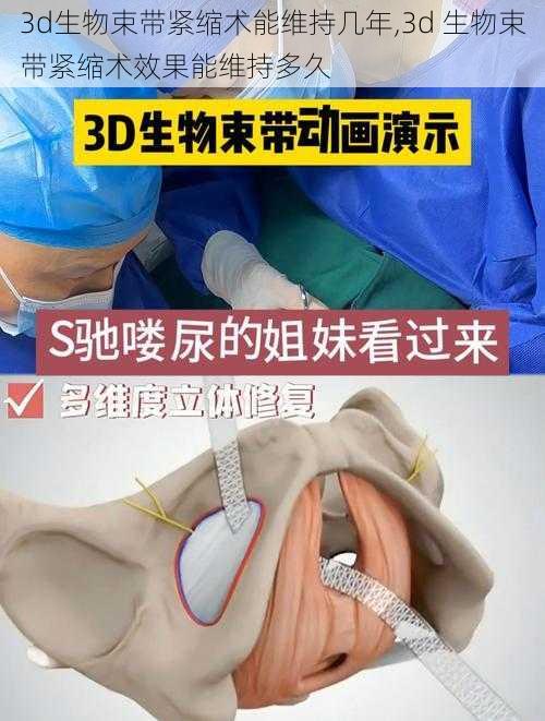 3d生物束带紧缩术能维持几年,3d 生物束带紧缩术效果能维持多久